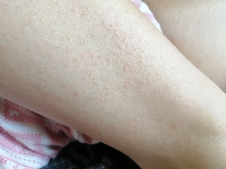 Rash on Elena’s legs before using Germivir tablets