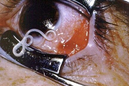 Worms in the eye of a person